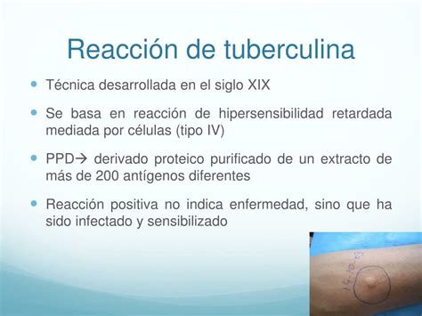 Ppt Tuberculosis Ppd Y Quimioprofilaxis Powerpoint Presentation