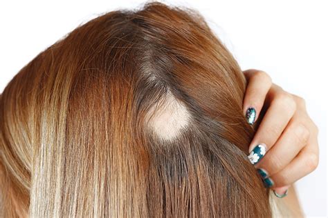 Tratamiento De La Alopecia Areata Cl Nica Capilar Medicina Est Tica