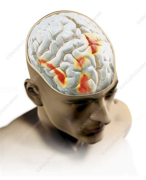 Placebo effect in the brain, artwork - Stock Image - P335/0082 - Science Photo Library