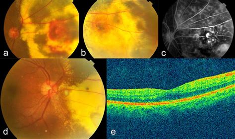 Fundus Photo Of Right Eye Upon First Examination Showing Extensive Download Scientific Diagram