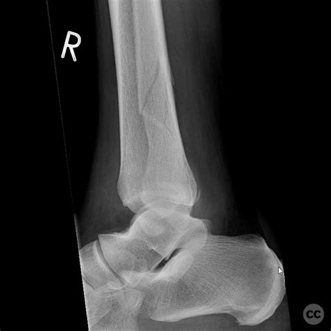 Pronation Abduction Pab Weber C Herscovici B Bimalleolar Ankle Fracture