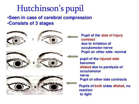 Head Injuries