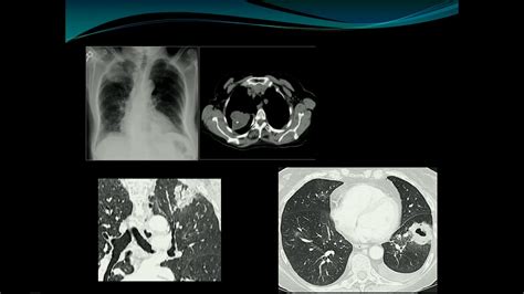 Lung Nodule Fleischner Criteria