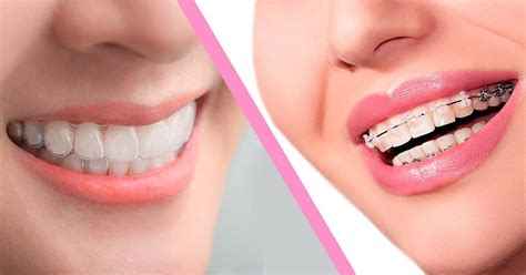 Difference Between Invisalign And Braces Smile Makeover