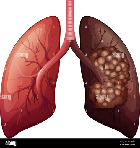 Normal Lungs X Ray Imágenes Vectoriales De Stock Alamy