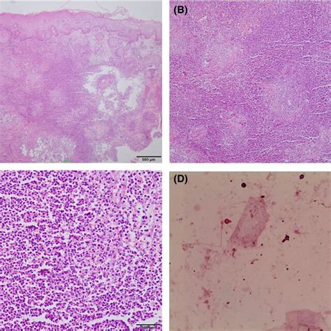 Skin Biopsy Showed Focal Acanthosis And Diffuses Mixed Infiltration Of