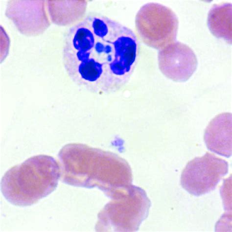 Timeline Of Patient S Hospitalization For Anemia Followed By Anaplasma