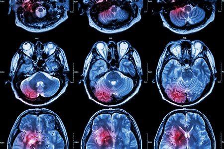 Brain Lesion Prevention - Blue Ridge Radiation Oncology - BRRO