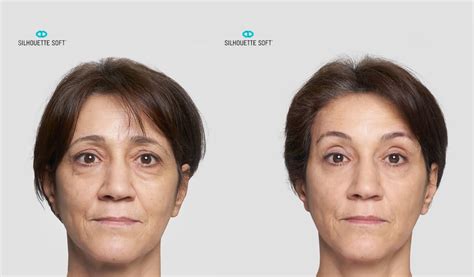 Collagen Stimulating Thread Lifts Non Surgical Facelift Bioscor