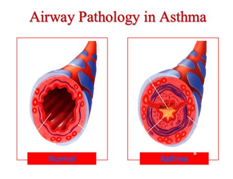 Pulmonology Asthma Flashcards Quizlet