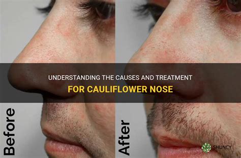 Understanding The Causes And Treatment For Cauliflower Nose Shuncy