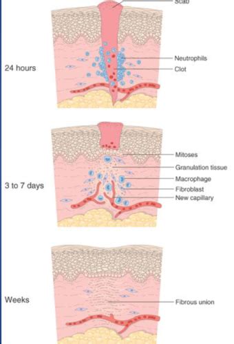 Surgery Wound Healing Flashcards Quizlet