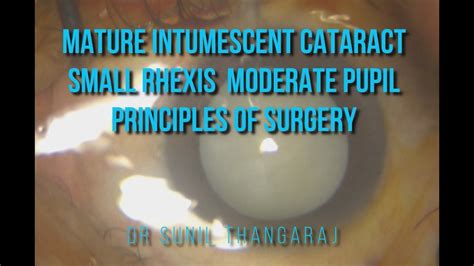 The Mature Intumescent Cataract Small Rhexis Moderate Pupil