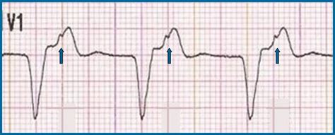 The Basics Of Paced Rhythms Ecg Medical Training