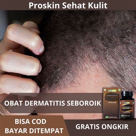 Jual Obat Dermatitis Seboroik Obat Penghilang Kulit Gatal Bersisik