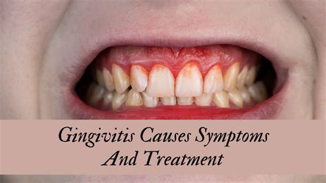 Gingivitis Causes Symptoms And Treatment