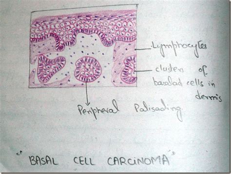 Histology Slides Database: Basal Cell Carcinoma Histopathology Diagrams