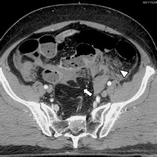 PDF Bowel And Mesenteric Injuries From Blunt Abdominal Trauma A Review