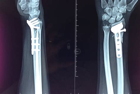 Distal Radius Fracture