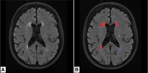 Effects Of White Matter Hyperintensities On Brain Connectivity And