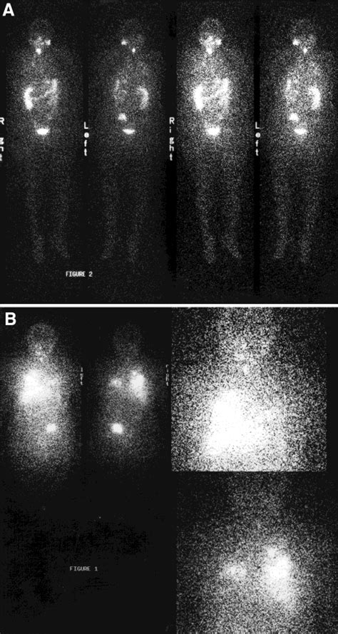 A Whole Body Scan Following 1 Mci 123 I Demonstrates Download