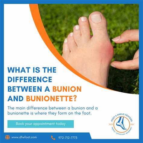 What Is The Difference Between A Bunion And Bunionette Foot Ankle