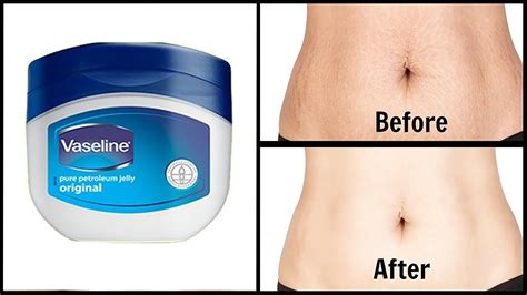 How To Apply Vaseline And Aloe Vera Gel Get Rid Of Stretch Marks At Home Youtube