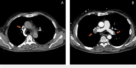 CTA findings. A: Computed tomography angiography (CTA) scan of the ...