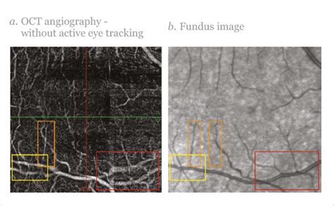 Advancing OCT Angiography