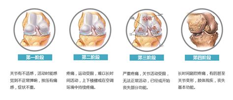 Svf治疗骨关节炎 瑞思坦生物 江苏瑞思坦生物科技有限公司