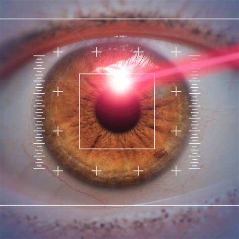 LASIK Or LASEK What Are The Differences Ophthalmon