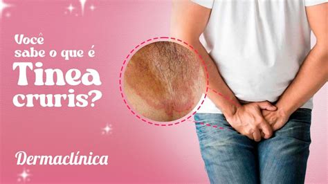 Tinea Cruris ou Dermatofitose O que é Como tratar Como evitar