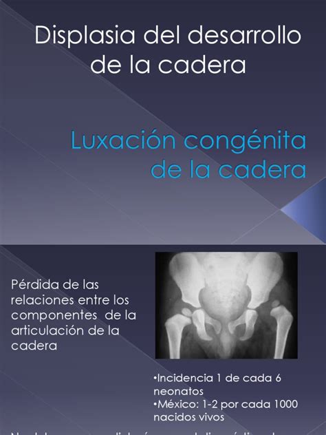 Luxación Congénita De La Caderapptx