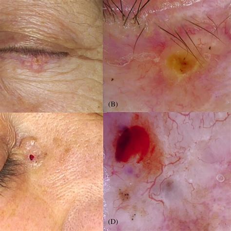 A Multiphase Mohs Micrographic Surgery Procedure Performed On A Basal Download Scientific