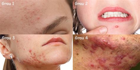 Graus da acne conheça a causa e os tratamentos Dicas da Jaque