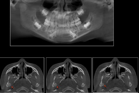 Caso N Fractura Mandibular Cdi Per