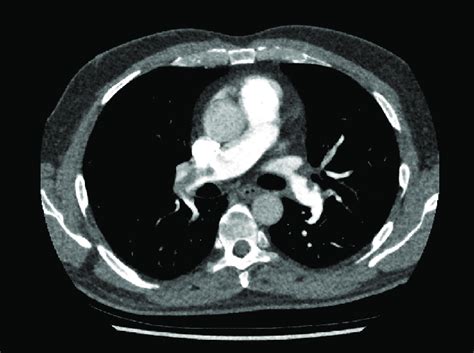 Ct Pulmonary Angiogram Showing Bilateral Pulmonary Embolism With Right Download Scientific