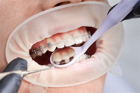 Understanding The Advantages Disadvantages Of Ceramic Braces