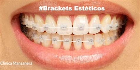 Brackets Estéticos Todo Sobre los Brackets Esteticos