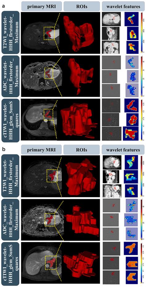 Multiparametric MRI Based Radiomics Analysis For Prediction Of Lymph