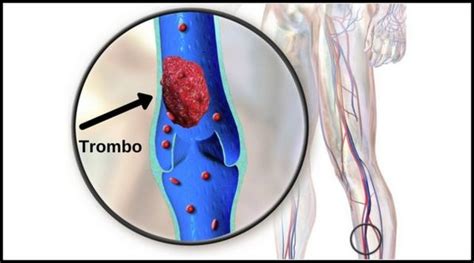 Quais os sintomas da trombose venosa profunda Médico Responde