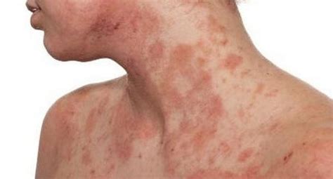 Dermatitis Atópica La Enfermedad De La Piel Que Genera Depresión Y