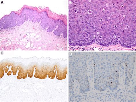 Human Papillomavirusassociated Severe Dysplasia A Hyperkeratosis