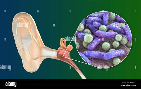 Otitis Media Infección Del Oído Ilustración Fotografía De Stock Alamy