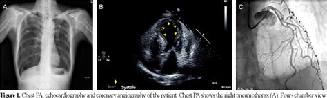 Figure 1 From Acute Cerebral Infarction Following Takotsubo