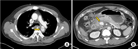 Initial Computed Tomography CT Scan A Contrast Enhanced CT Scan Of