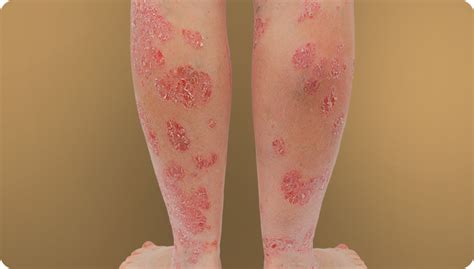 Common Psoriasis Types | psoriasisSPEAKS