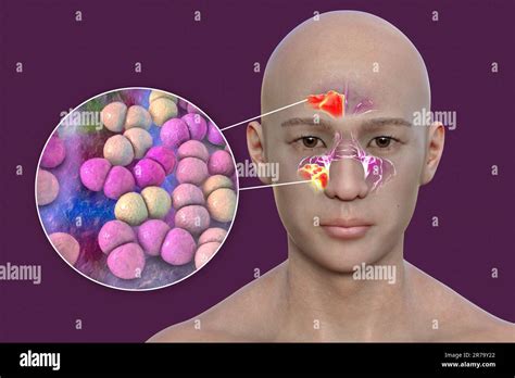 Streptococcus Pneumoniae Bacteria As A Cause Of Sinusitis D