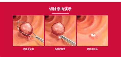 结肠息肉会癌变吗？医生带你揭开结肠息肉神秘的面纱结肠息肉面纱医生腺瘤性息肉炎性息肉癌变病理 健康界