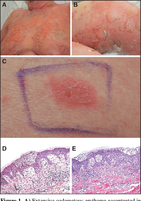 Figure 1 From Acute Generalized Exanthematous Pustulosis Agep